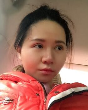 路卫国给我做隆鼻整形后鼻子变得特别秀丽