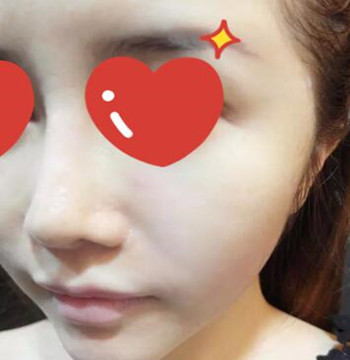 做了拉皮除皱 我的皮肤越来越紧致光滑了