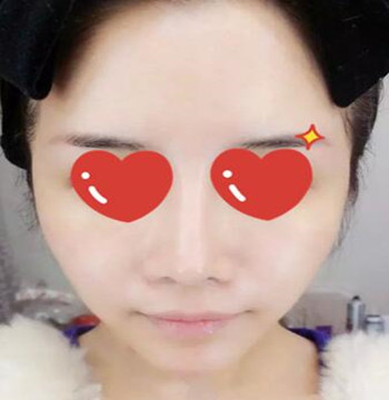 做了拉皮除皱 我的皮肤越来越紧致光滑了