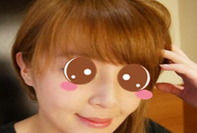 膨体隆鼻让我的颜值更上一层