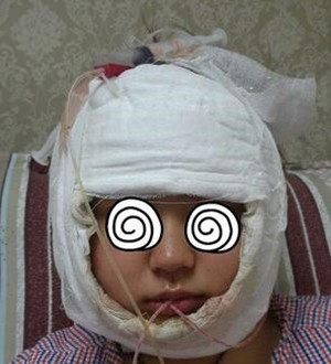 柳大烈教授帮我做磨骨瘦脸 真的很安有果也很棒