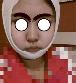 柳大烈教授帮我做磨骨瘦脸 真的很安有果也很棒