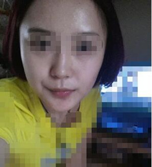 柳大烈教授帮我做磨骨瘦脸 真的很安有果也很棒