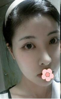 做了磨颧骨手术的我从小鸭子变成白天鹅 谢谢柳大烈教授