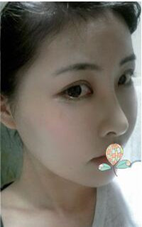 做了磨颧骨手术的我从小鸭子变成白天鹅 谢谢柳大烈教授