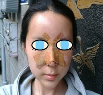 北京八大处整容医院膨体隆鼻案例分享~