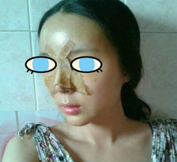 北京八大处整容医院膨体隆鼻案例分享~