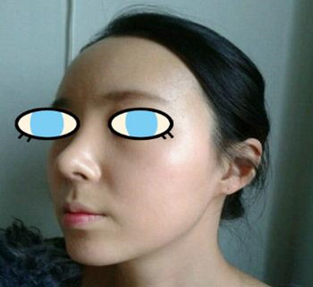 北京八大处整容医院膨体隆鼻案例分享~