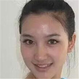 去年做的注射B****微整形，你们看看恢复前后的对比照片~~~