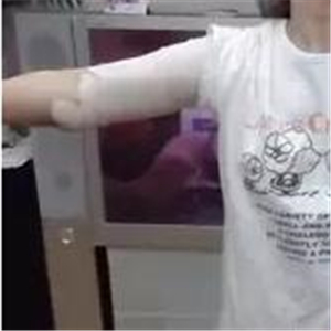 手臂吸脂手术八个月了，看看我的前后对比果图片吧~~