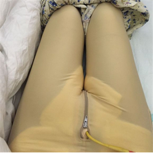 大腿部吸脂减肥一个月了，晒一下恢复过程和对比照片哇~~