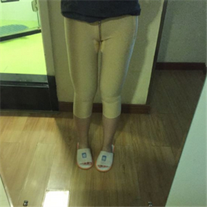 大腿部吸脂减肥一个月了，晒一下恢复过程和对比照片哇~~