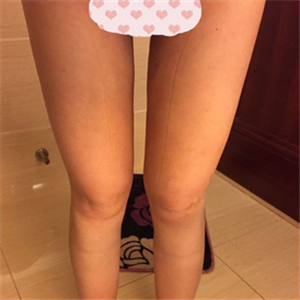 大腿部吸脂减肥一个月了，晒一下恢复过程和对比照片哇~~