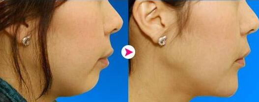 垫下巴整形价格