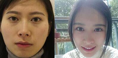 大腿吸脂做自体脂肪面部填充三个月的前后对比照片