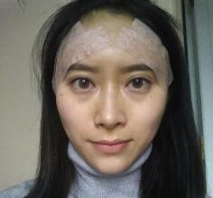 自体脂肪面部填充术后照片