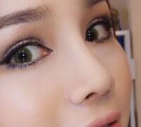 隆鼻整形真实案例恢复过程分享