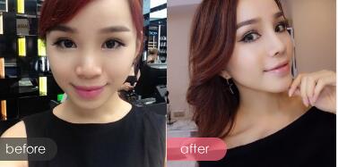 隆鼻整形前后对比图