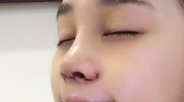 隆鼻整形手术后恢复图