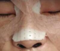 自体软骨隆鼻手术果和恢复过程图分享