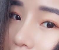 自体软骨隆鼻手术果和恢复过程图分享