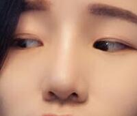 自体软骨隆鼻手术果和恢复过程图分享