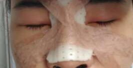 自体耳软骨隆鼻整形后的图片