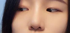 自体软骨隆鼻手术果和恢复过程图分享