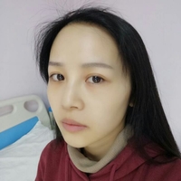 从大腿抽脂做的自体脂肪面部填充现在为大家分享分享变美过程