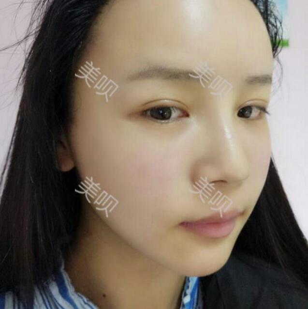 从大腿抽脂做的自体脂肪面部填充现在为大家分享分享变美过程