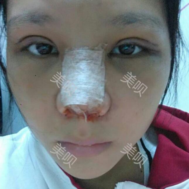 自体软骨隆鼻后同时说我像混血了哈哈··