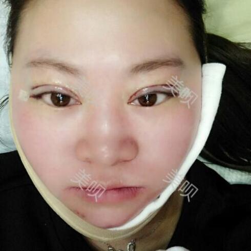 大家看看我在常州曙光做的双眼皮+开外眼角怎么样