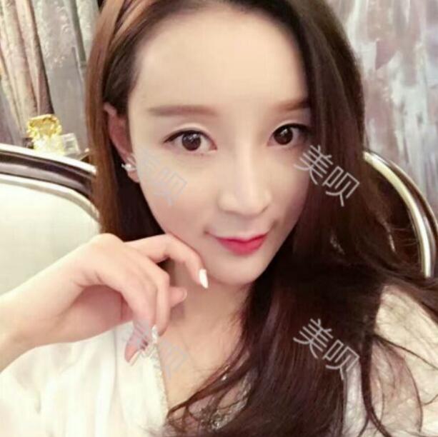 产后自体脂肪面部填充后老公都夸我更漂亮了这钱没白花哦