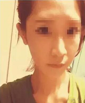 【20天康复记录】隆鼻+面部脂肪填充，遇见更美的自己