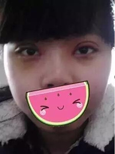 【真人案例】双眼皮手术后，见证我的美!