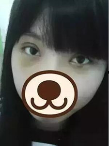 【真人案例】双眼皮手术后，见证我的美!
