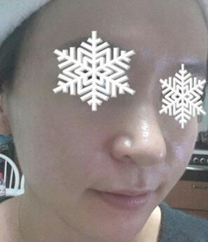 光子嫩肤后，整个人漂亮多了