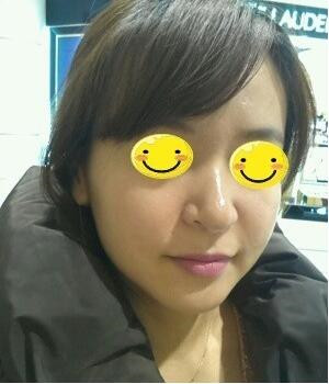 光子嫩肤后，整个人漂亮多了