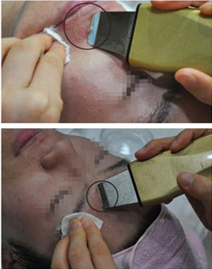 激光祛痘果怎么样？激光祛痘前后过程对比图