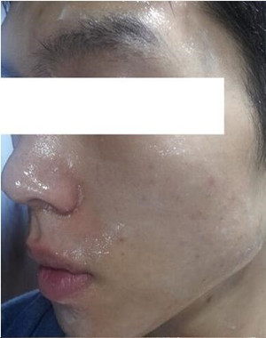 激光祛痘果怎么样？激光祛痘前后过程对比图