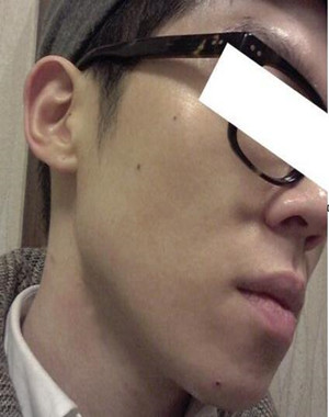 激光祛痘果怎么样？激光祛痘前后过程对比图