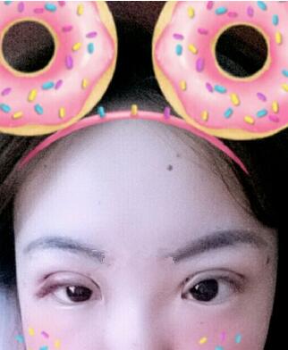 双眼皮恢复过程分享