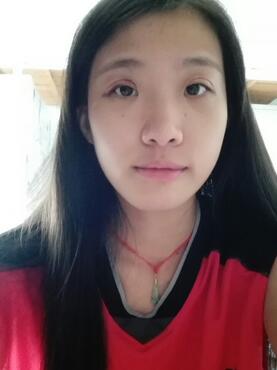 埋线双眼皮15天恢复记录