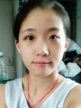 埋线双眼皮15天恢复记录