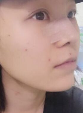 硅胶假体隆鼻给我带来抄好看的鼻子
