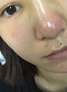 硅胶假体隆鼻给我带来抄好看的鼻子