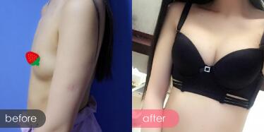 假体隆胸，假体隆胸价格为28000元