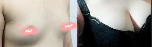 自体脂肪隆胸前后对比图