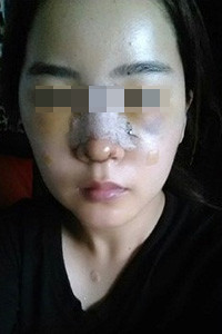 膨体隆鼻手术前后对比照片，真实案例分享！