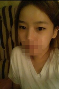 膨体隆鼻手术前后对比照片，真实案例分享！